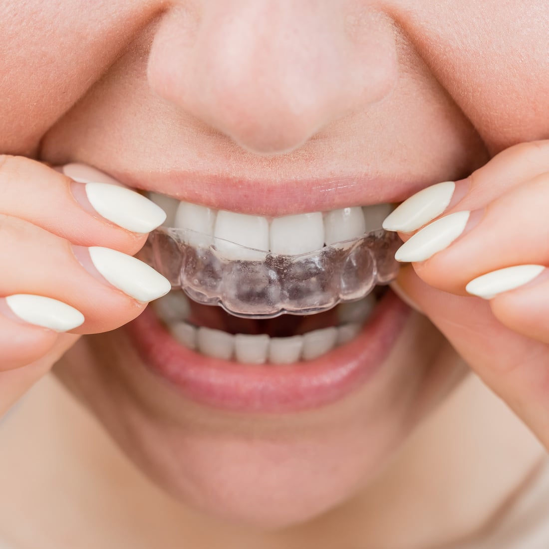 Close-up Portrait of a Woman Putting on a Transparent Plastic Retainer. a Girl Corrects a Bite with the Help of an Orthodontic Device